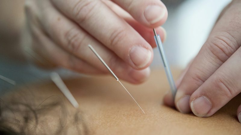 Acupuncture needles being placed during a treatment